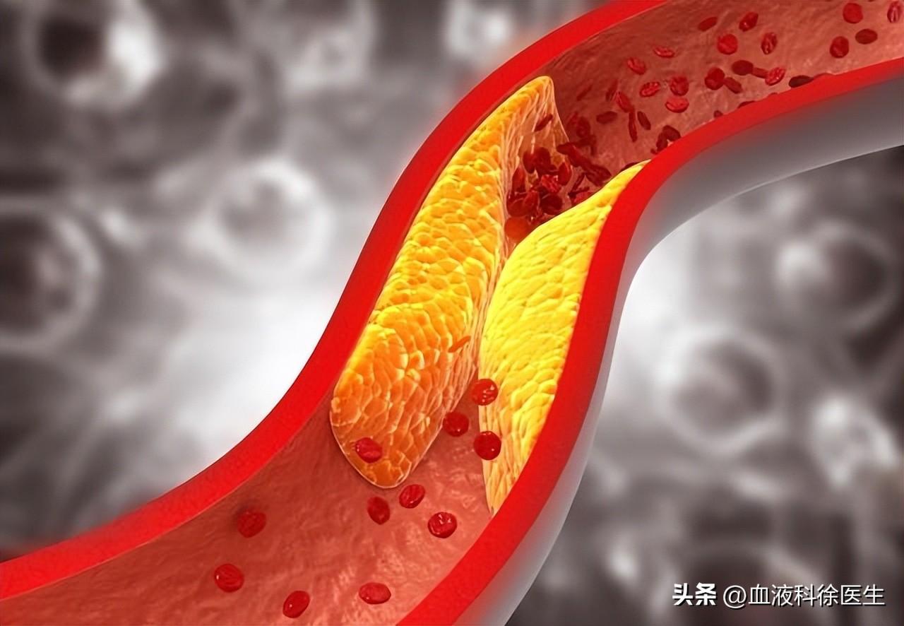 最新血管堵塞治療方法的研究進(jìn)展及成果概述